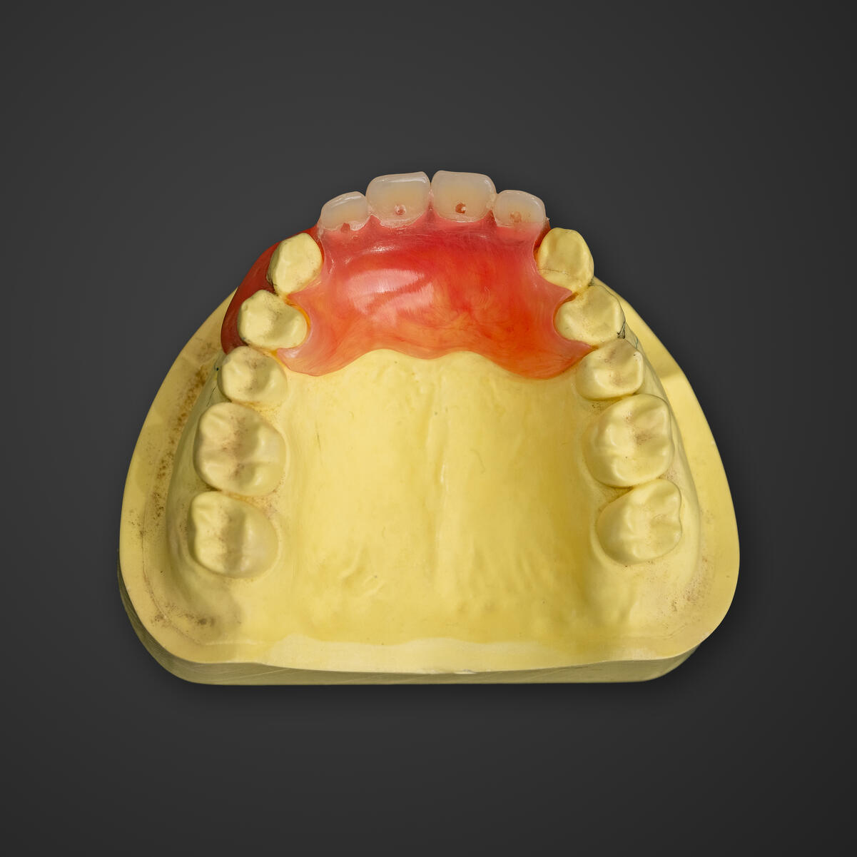 ノンクラスプデンチャー(部分入れ歯)