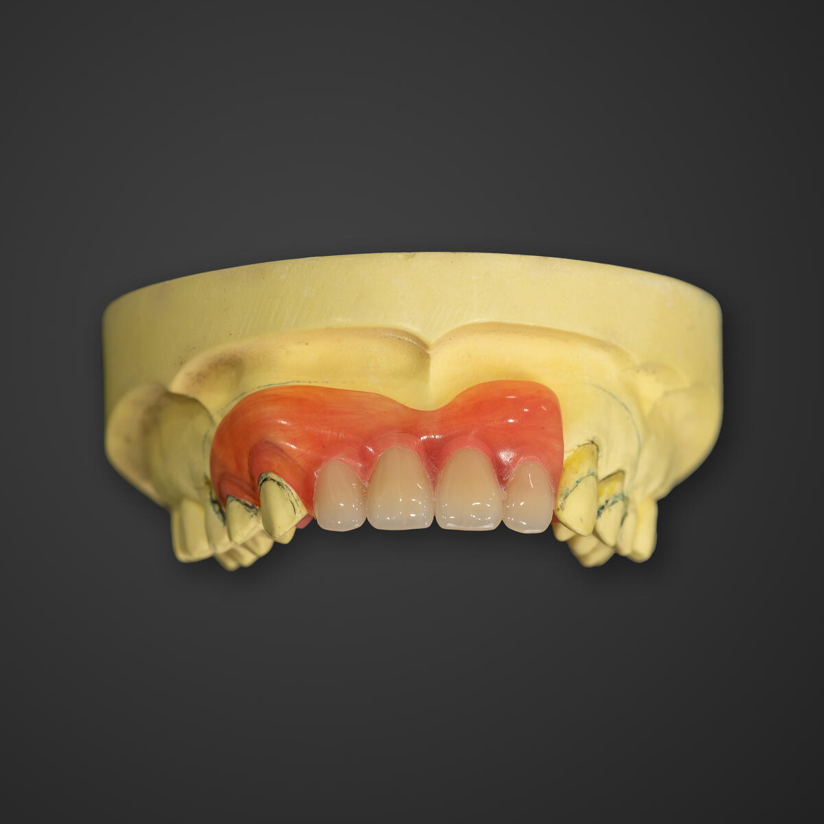 ノンクラスプデンチャー(部分入れ歯)