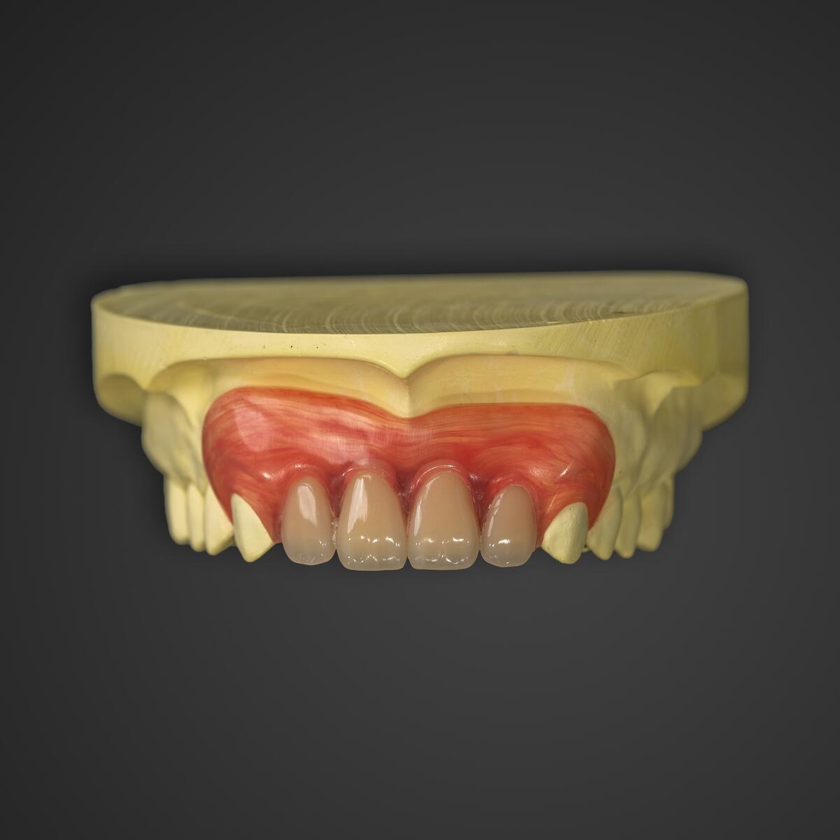 ノンクラスプデンチャー(部分入れ歯)