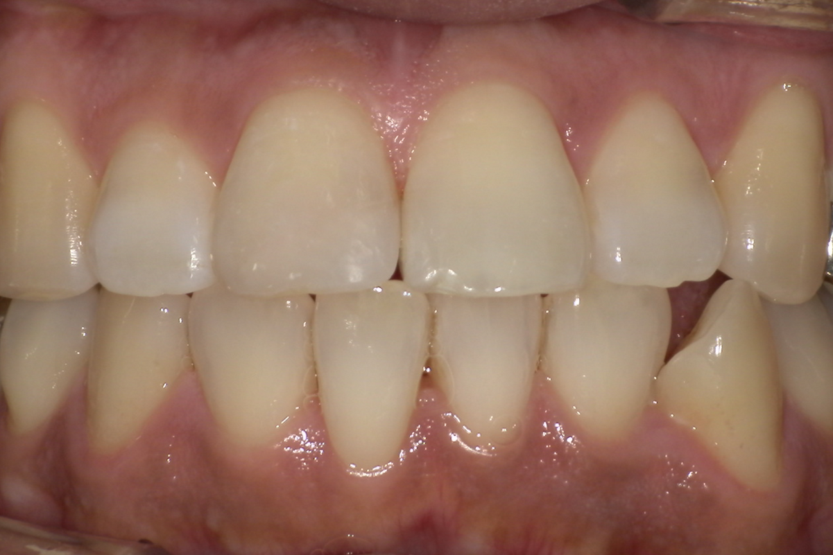 After / ダイレクトボンディング(前歯)