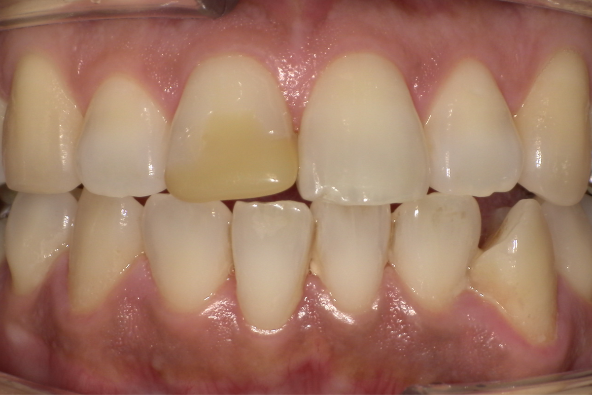 Before / ダイレクトボンディング(前歯)