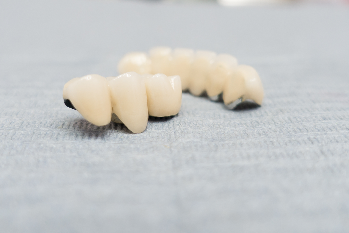 メタルボンド冠