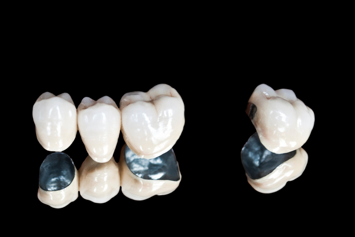 メタルボンド冠