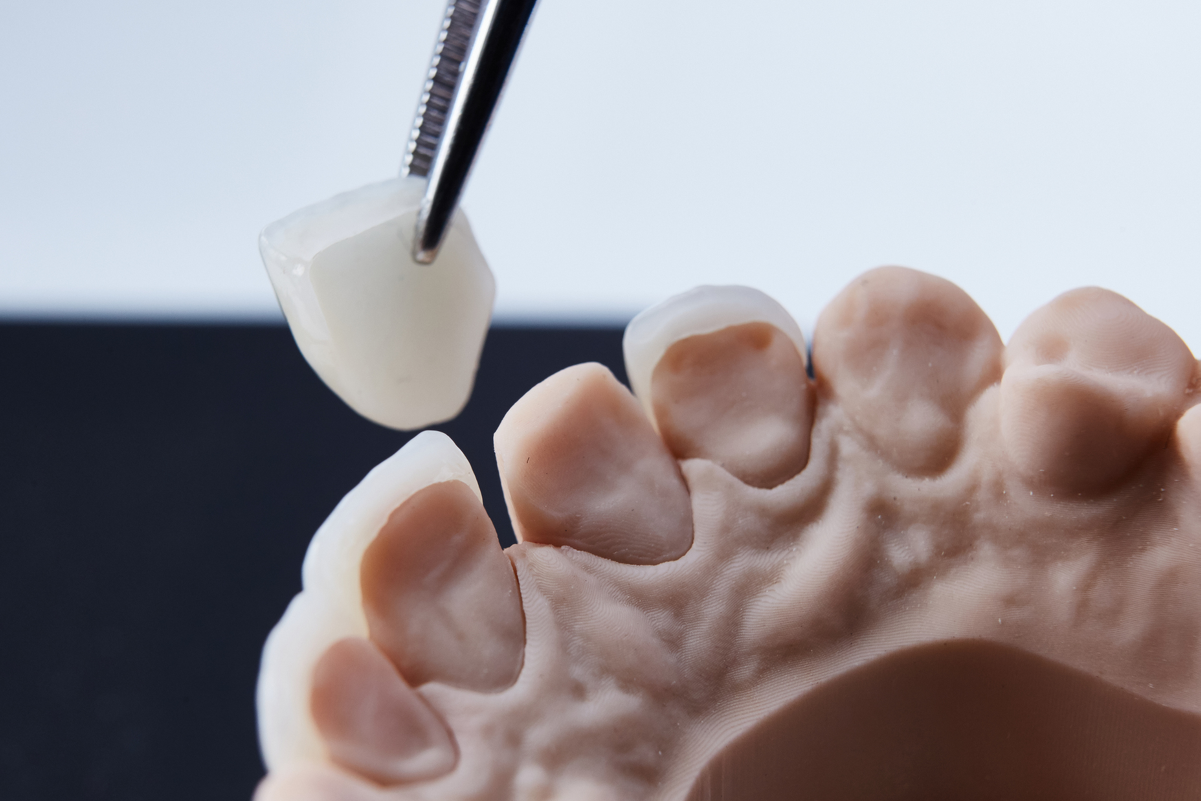 ラミネートベニア