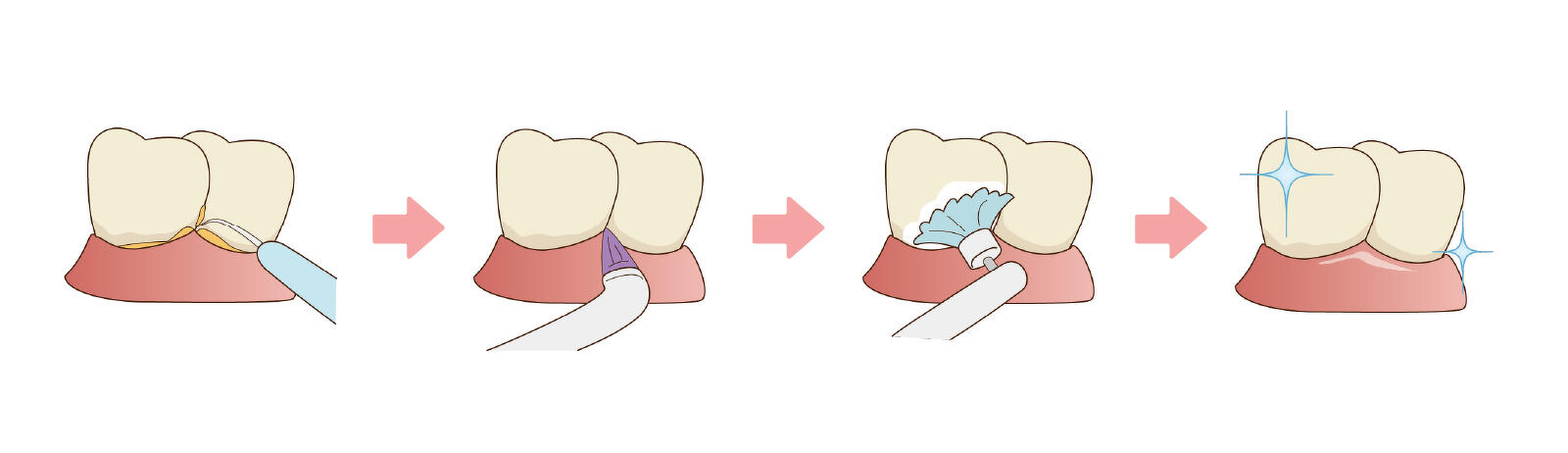PMTC(専門的なお口のクリーニング)