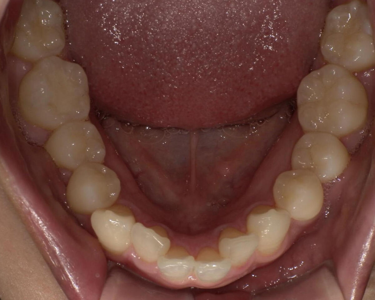 After / ダイレクトボンディング(奥歯)