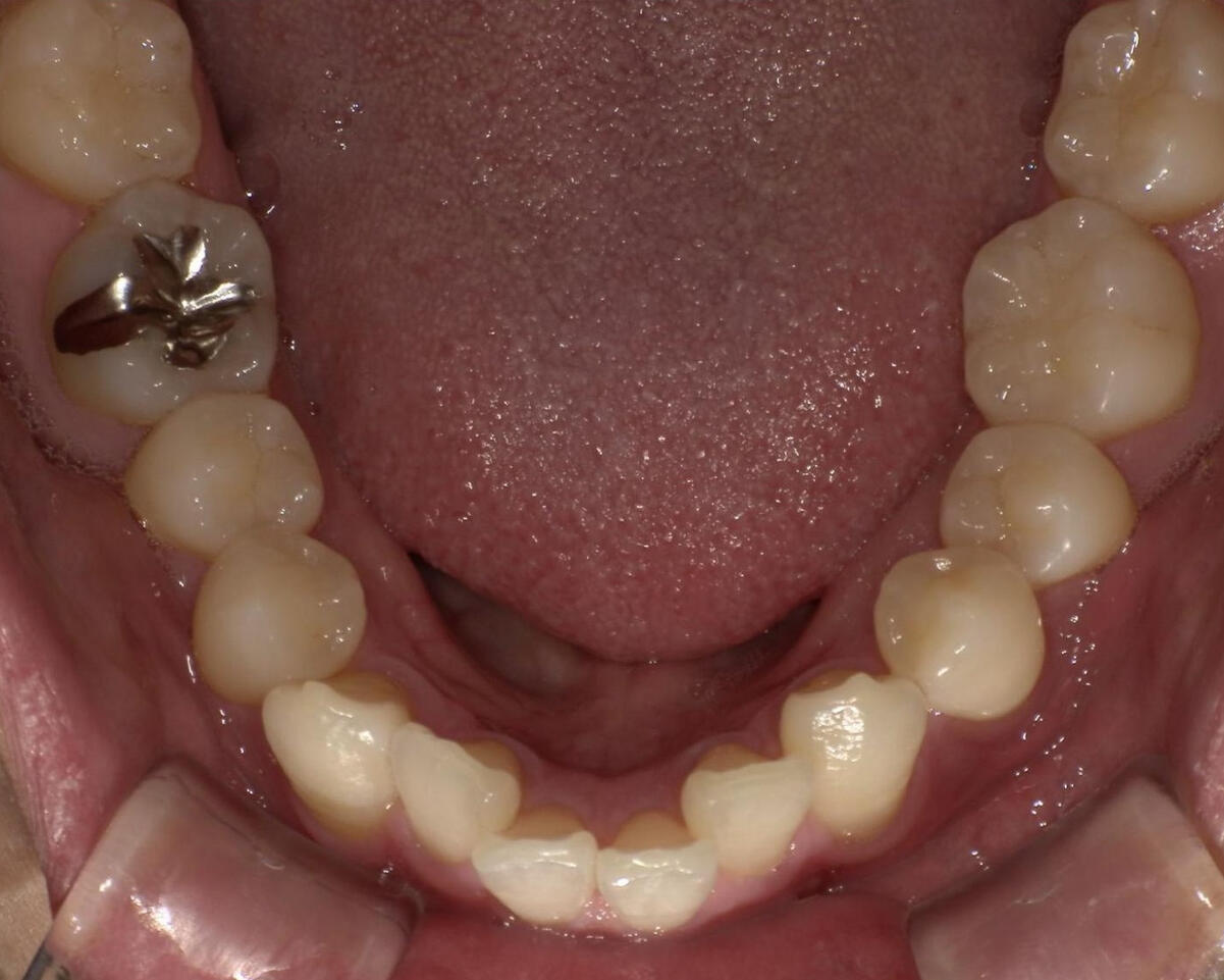 Before / ダイレクトボンディング(奥歯)